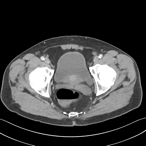 File:Active diverticular hemorrhage (Radiopaedia 39415-41725 Axial C+ portal venous phase 65).png