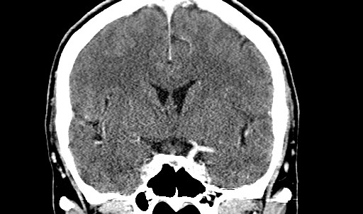 File:Active neurocysticercosis before and after therapy (Radiopaedia 71710-82099 Coronal C+ delayed 36).jpg
