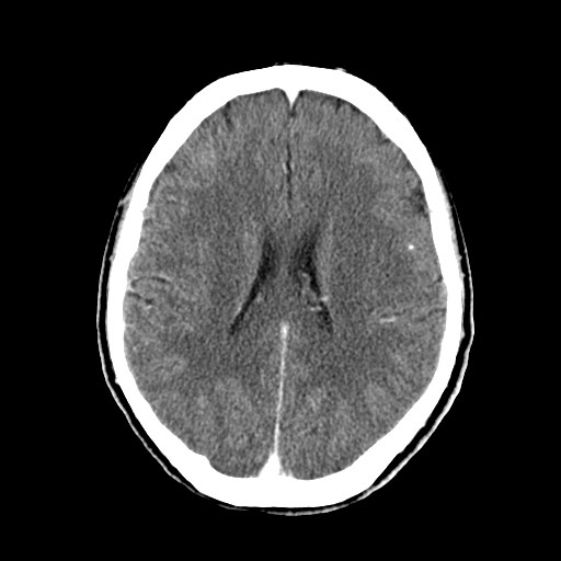 File:Active neurocysticercosis before and after therapy (Radiopaedia 71710-82100 Axial C+ delayed 58).jpg