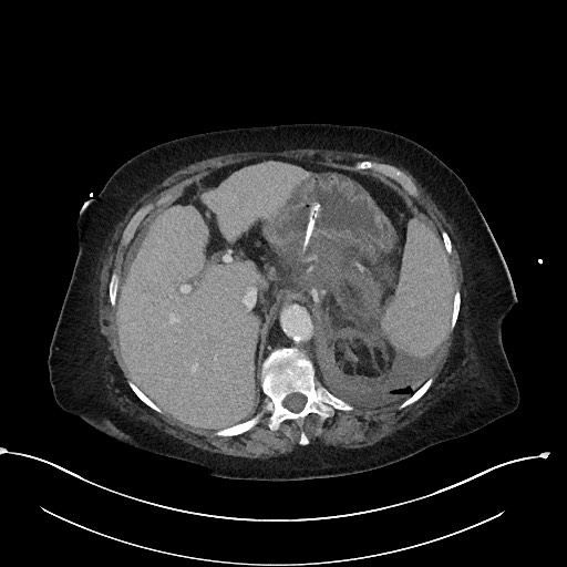 File:Active renal extravasation with large subcapsular and retroperitoneal hemorrhage (Radiopaedia 60975-68796 Axial 311).jpg