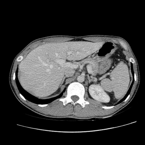 Acute appendicitis (Radiopaedia 27049-27227 Axial C+ portal venous phase 17).jpg
