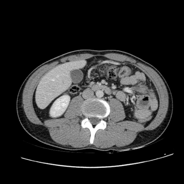 Acute appendicitis (Radiopaedia 27049-27227 Axial C+ portal venous phase 36).jpg
