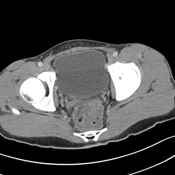 Acute appendicitis (Radiopaedia 32614-33572 Axial C+ portal venous phase 62).jpg