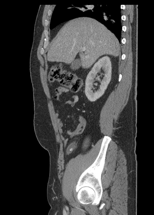 Acute appendicitis (Radiopaedia 48511-53463 Sagittal C+ portal venous phase 47).jpg