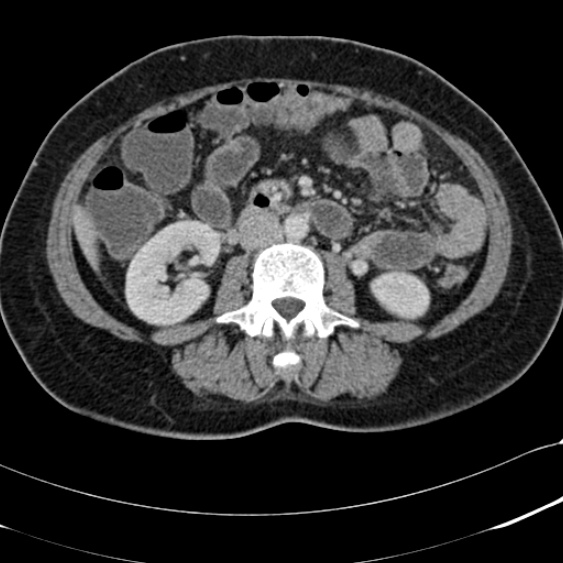 Acute appendicitis (Radiopaedia 48792-53822 Axial C+ portal venous phase 57).jpg