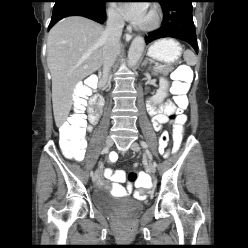 File:Acute appendicitis (Radiopaedia 52672-58589 Coronal C+ portal venous phase 65).jpg