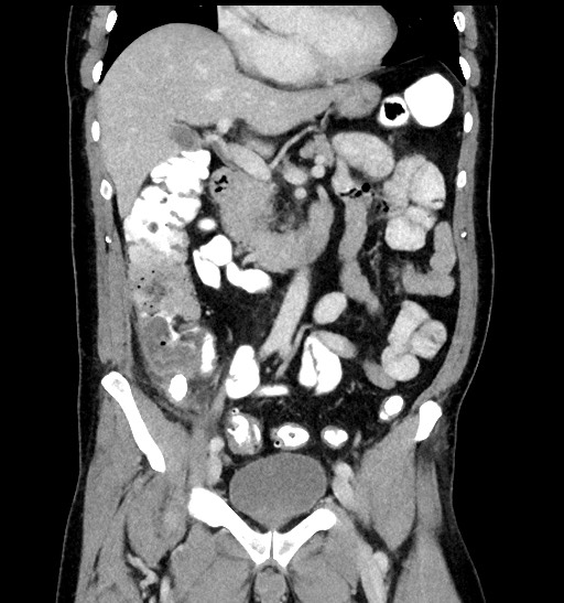 Acute appendicitis (Radiopaedia 77016-88960 Coronal C+ portal venous phase 46).jpg