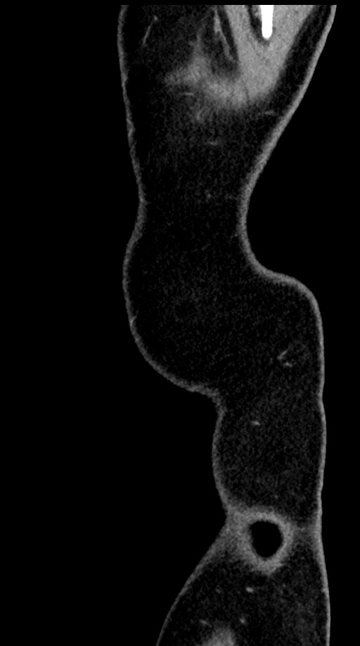 Acute appendicitis (Radiopaedia 77016-88960 Sagittal C+ portal venous phase 3).jpg