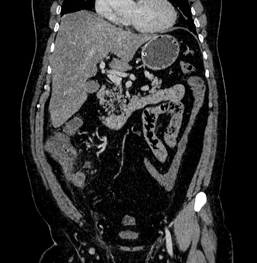 Acute appendicitis (Radiopaedia 79950-93224 Coronal C+ portal venous phase 38).jpg
