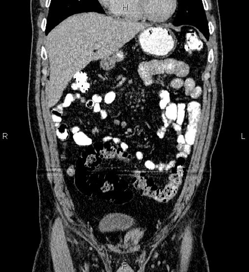 Acute appendicitis (Radiopaedia 84780-100240 Coronal C+ portal venous phase 24).jpg