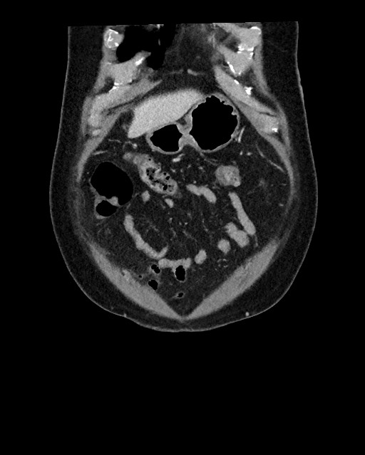 Acute appendicitis - large appendicoliths (Radiopaedia 61805-69820 Coronal C+ portal venous phase 27).jpg