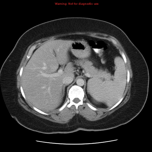 Acute appendicitis complicated by ovarian vein thrombophlebitis (Radiopaedia 16172-15851 Axial C+ portal venous phase 26).jpg