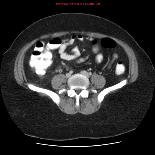 Acute appendicitis complicated by ovarian vein thrombophlebitis (Radiopaedia 16172-15851 Axial C+ portal venous phase 61).jpg