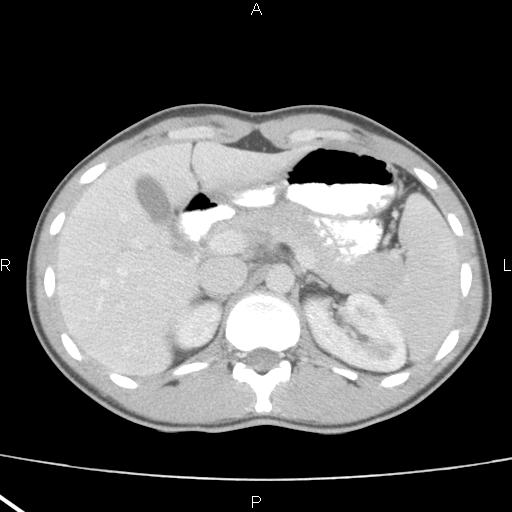 File:Acute appendicitis with CT arrowhead sign (Radiopaedia 21474-21411 Axial C+ portal venous phase 10).jpg