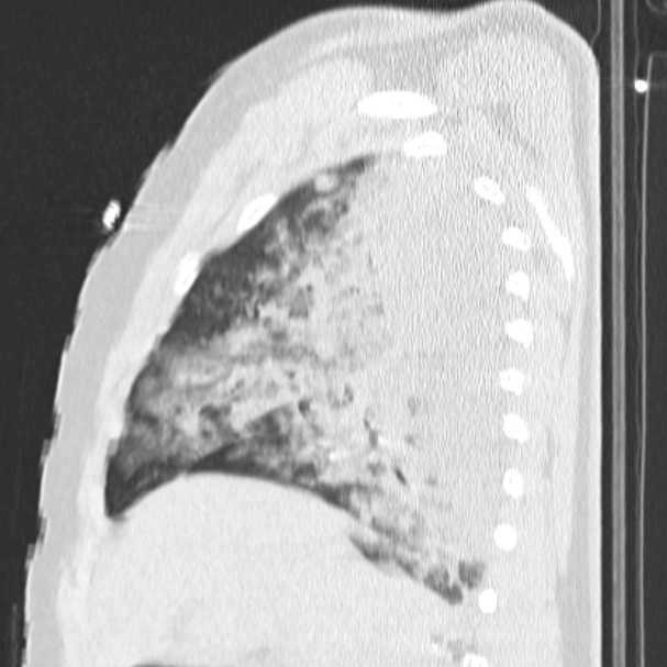 Acute aspiration pneumonitis (Radiopaedia 33605-34703 Sagittal lung window 28).jpg