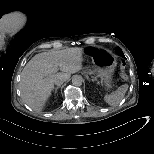 Acute aspiration pneumonitis (Radiopaedia 55642-62166 Axial liver window 58).jpg