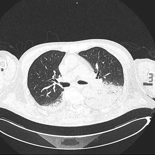 File:Acute aspiration pneumonitis (Radiopaedia 55642-62166 Axial lung window 69).jpg