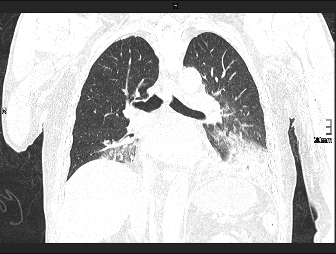 Acute aspiration pneumonitis (Radiopaedia 55642-62166 Coronal lung window 59).jpg