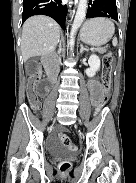 Acute bowel ischemia (Radiopaedia 87695-104114 Coronal C+ portal venous phase 238).jpg