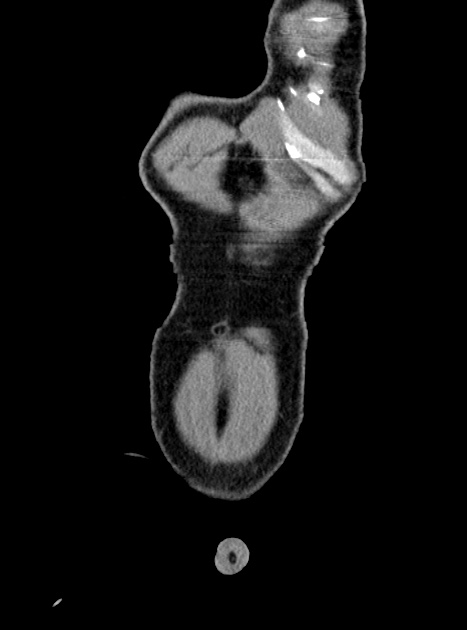 Acute bowel ischemia (Radiopaedia 87695-104114 Coronal C+ portal venous phase 65).jpg