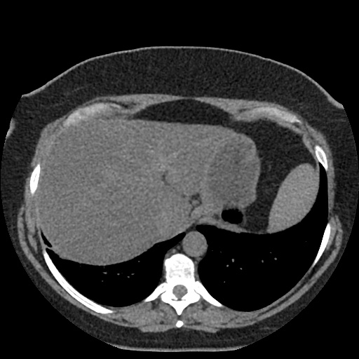 File:Acute cholecystitis and ureteric colic (Radiopaedia 42330-45444 Axial prone 4).jpg