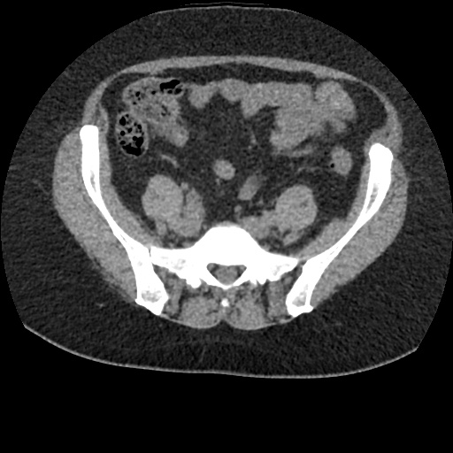 File:Acute cholecystitis and ureteric colic (Radiopaedia 42330-45444 Axial prone 76).jpg