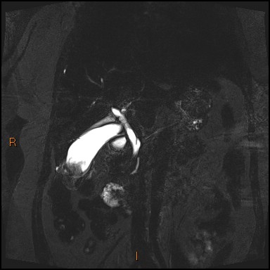 File:Acute cholecystitis with gallbladder neck calculus (Radiopaedia 42795-45971 Coronal Turbo spin echo 23).jpg