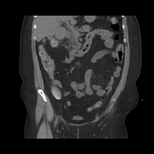 Acute cholecystitis with tensile fundus sign (Radiopaedia 71394-81723 Coronal non-contrast 59).jpg