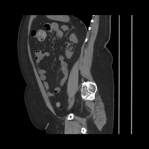 Acute cholecystitis with tensile fundus sign (Radiopaedia 71394-81723 Sagittal non-contrast 109).jpg