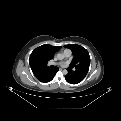 File:Acute complicated calculous cholecystitis (Radiopaedia 55202-61587 Axial C+ delayed 4).jpg