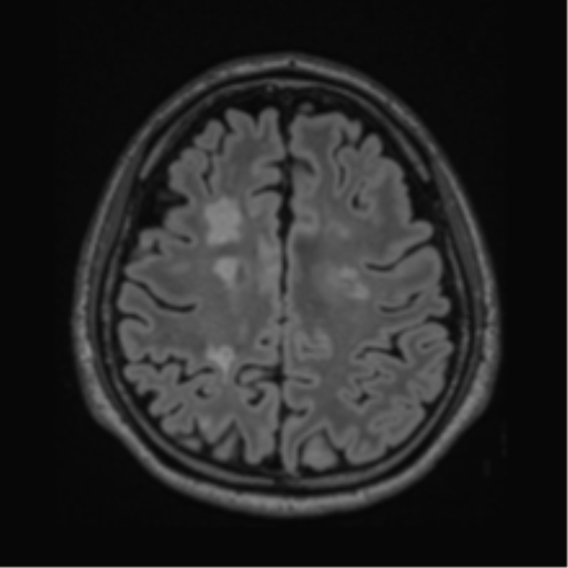 Acute disseminated encephalomyelitis (ADEM)- Anti-NMDA receptor encephalitis (Radiopaedia 54920-61201 Axial FLAIR 49).png