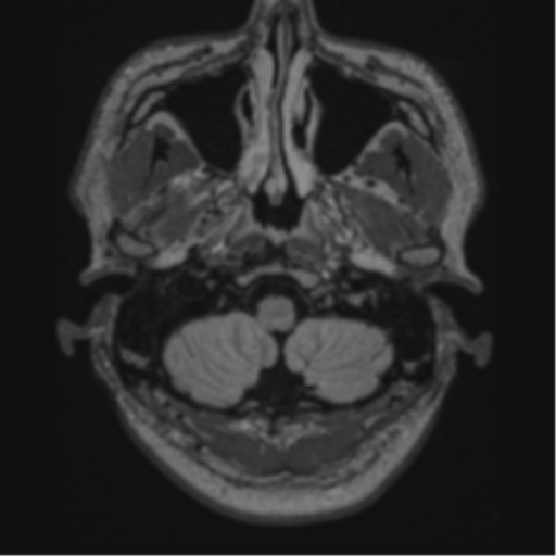 Acute disseminated encephalomyelitis (ADEM)- Anti-NMDA receptor encephalitis (Radiopaedia 54920-61201 Axial FLAIR 6).png