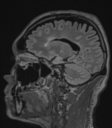 Acute disseminated encephalomyelitis (ADEM)- Anti-NMDA receptor encephalitis (Radiopaedia 54920-61201 Sagittal FLAIR 35).png
