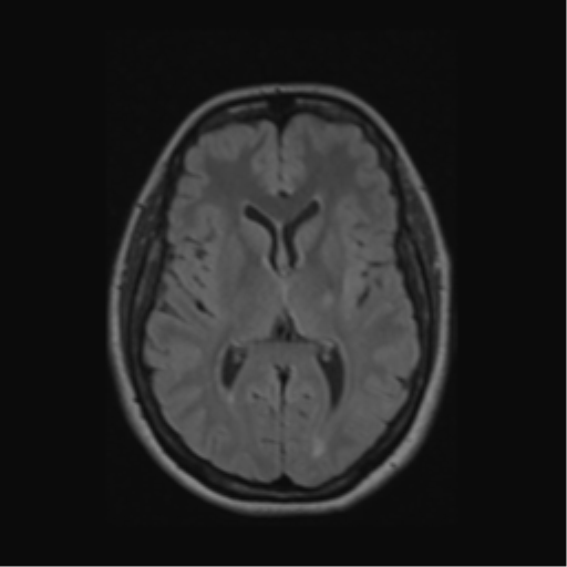 Acute disseminated encephalomyelitis (ADEM) (Radiopaedia 38073-40065 Axial FLAIR 33).png