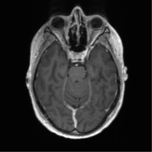 Acute disseminated encephalomyelitis (ADEM) (Radiopaedia 65319-74350 Axial T1 C+ 18).png