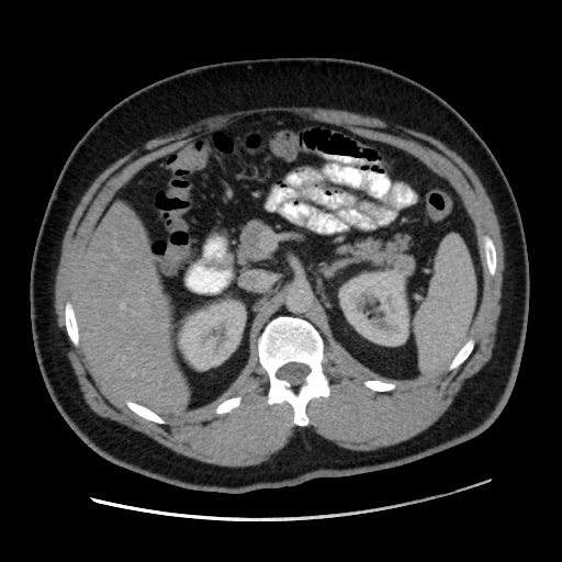 Acute diverticulitis with localized perforation (Radiopaedia 41296-44113 Axial C+ portal venous phase 31).jpg