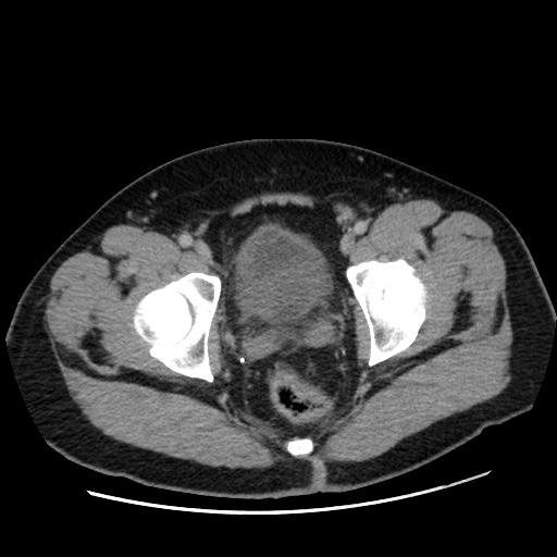File:Acute diverticulitis with localized perforation (Radiopaedia 41296-44113 Axial C+ portal venous phase 85).jpg