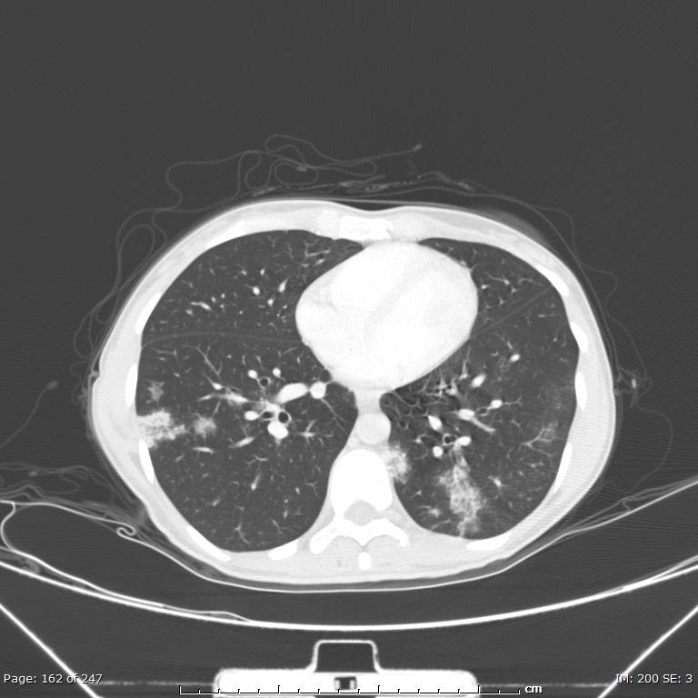 Acute eosinophilic pneumonia (Radiopaedia 48211-53073 Axial lung window 58).jpg