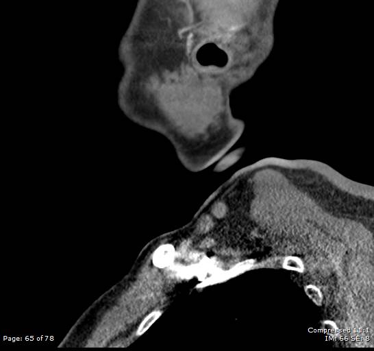 Acute epiglottitis (Radiopaedia 54375-60590 Sagittal C+ arterial phase 65).jpg