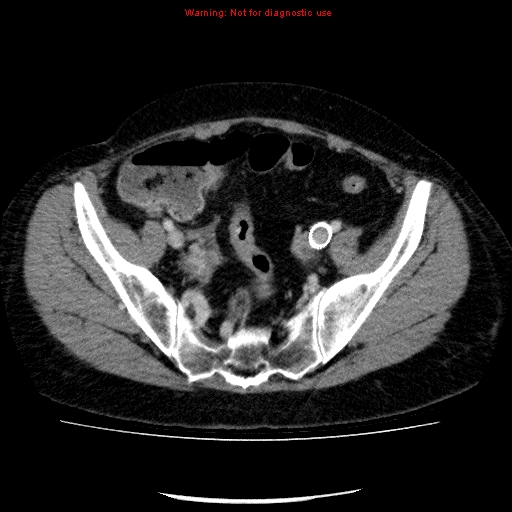 File:Acute gangrenous cholecystitis (Radiopaedia 10123-10661 Axial C+ portal venous phase 83).jpg