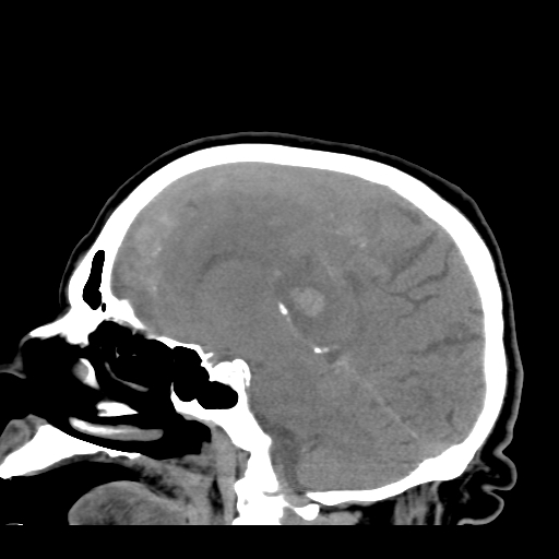 File:Acute hemorrhagic stroke (Radiopaedia 17507-17223 Sagittal non-contrast 25).jpg