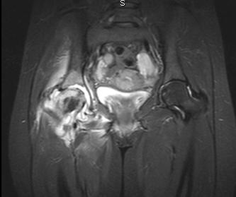 File:Acute hip arthritis (Radiopaedia 5460-7188 Coronal T2 fat sat 1).jpg