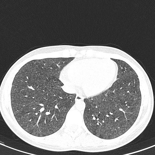 File:Acute hypersensitivity pneumonitis (Radiopaedia 85293-100870 Axial lung window 88).jpg