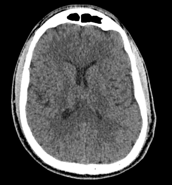 Acute ischemic stroke - posterior circulation territory (Radiopaedia 77670-89881 non-contrast 52).jpg