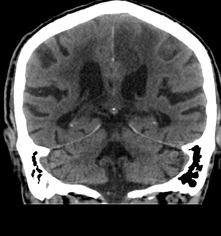 File:Acute left anterior cerebral artery territory infarction (Radiopaedia 51785-57578 Coronal non-contrast 39).jpg