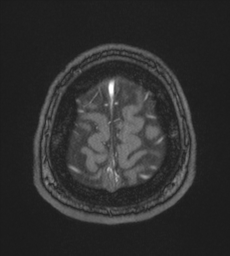 Acute left middle cerebral artery territory infarct with clot retrieval (Radiopaedia 47732-52433 Axial MRA 63).png