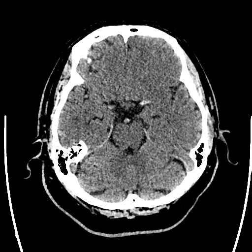 File:Acute left middle cerebral artery territory ischemic stroke (Radiopaedia 35688-37223 Axial non-contrast 25).png
