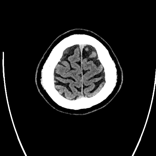 Acute left middle cerebral artery territory ischemic stroke (Radiopaedia 35688-37223 Axial non-contrast 79).png