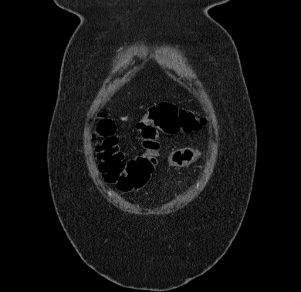 Acute mesenteric ischemia (Radiopaedia 80029-93316 Coronal C+ arterial phase 6).jpg