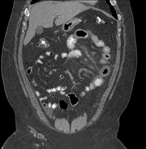 Acute mesenteric venous ischemia (Radiopaedia 46041-50383 Coronal C+ portal venous phase 29).jpg